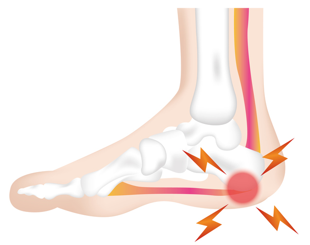 足底筋膜炎とは