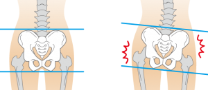イラスト-骨盤の歪みイメージ